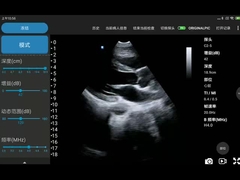 Pemindai Ultrasound Genggam Saku 5MHz untuk Diagnosis Jantung Seluler