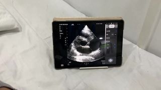 Probe Ultrasound Nirkabel Kepala Ganda untuk Jantung dan POCUS