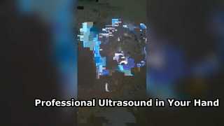 Ultrasonografi Transvaginal Portabel untuk Ginekologi Modern