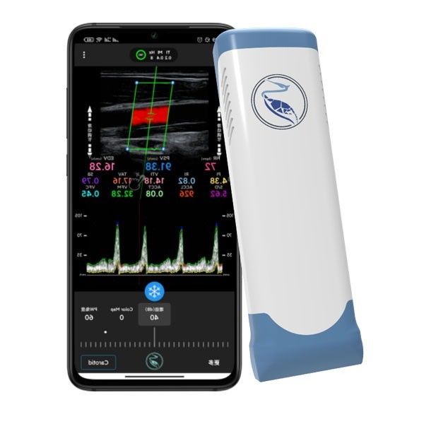 Pemindai USG Genggam Nirkabel Echo Color Doppler 100 Bingkai
